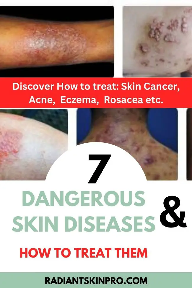 7 Dangerous Skin Diseases and How to Treat Them