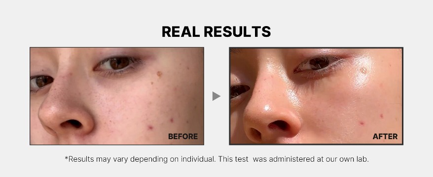 before and after use of medicube age r booster